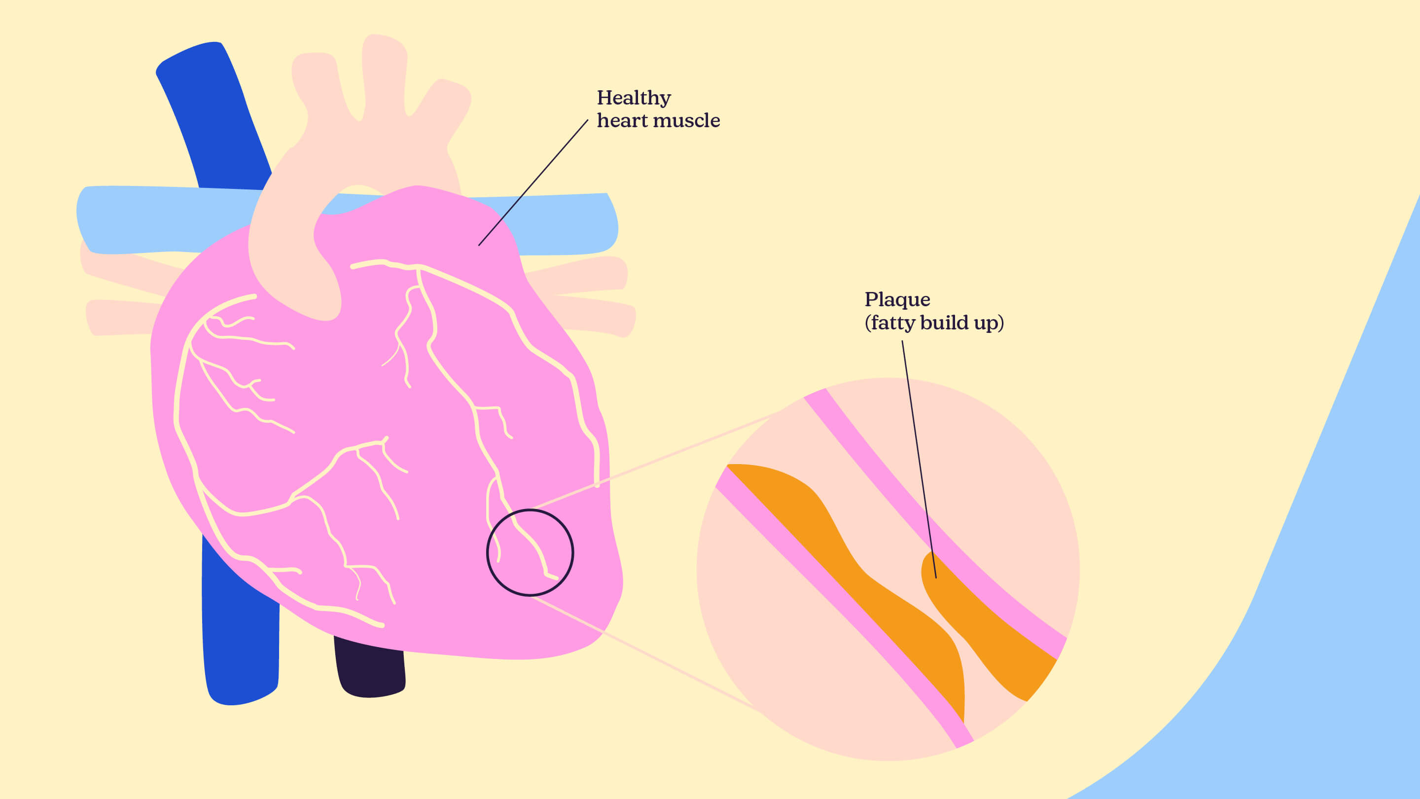 An illustration showing what fatty build up looks like in a heart muscle