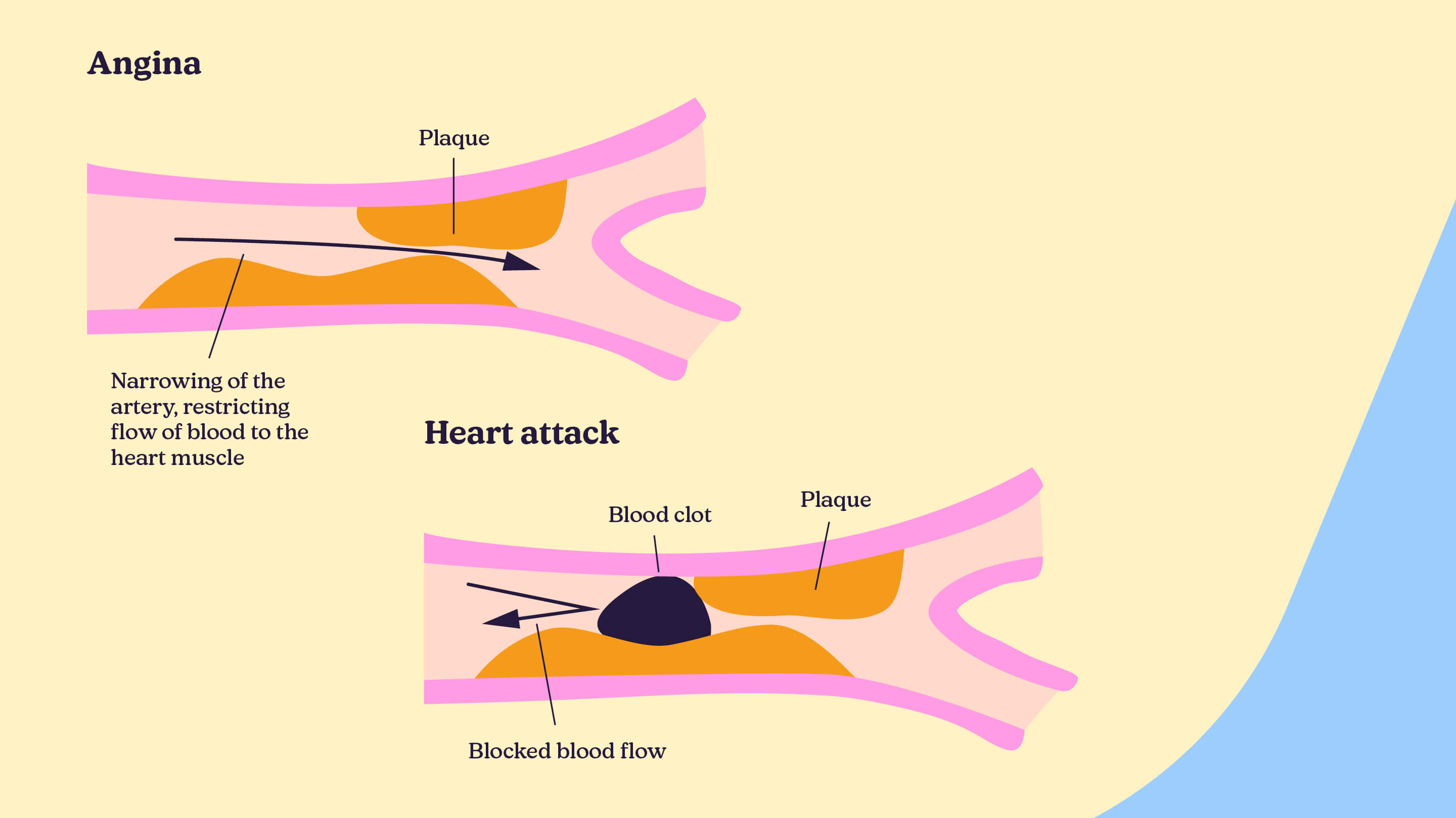 An illustration showing the effects of angina on an artery and the effects of a heart attach on an artery